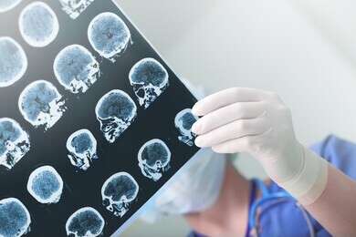 epilepsy - example image