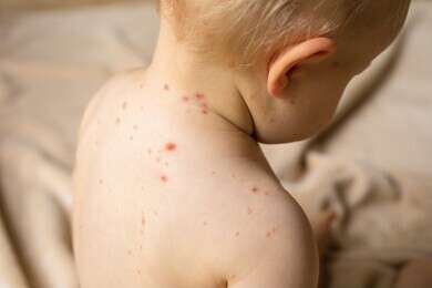 smallpox - example image